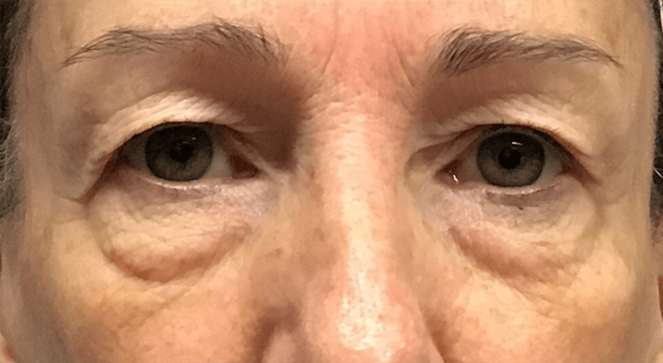 before morpheus8 skin tightening treatment on the eye area