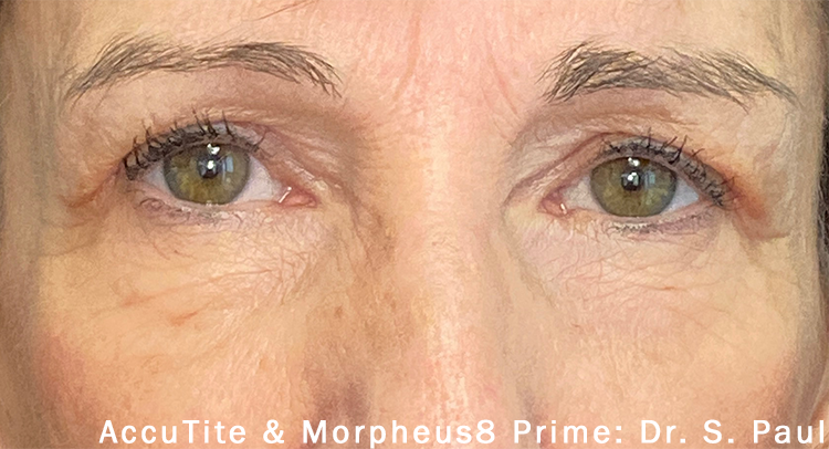 after morpheus8 skin tightening treatment on the eye area