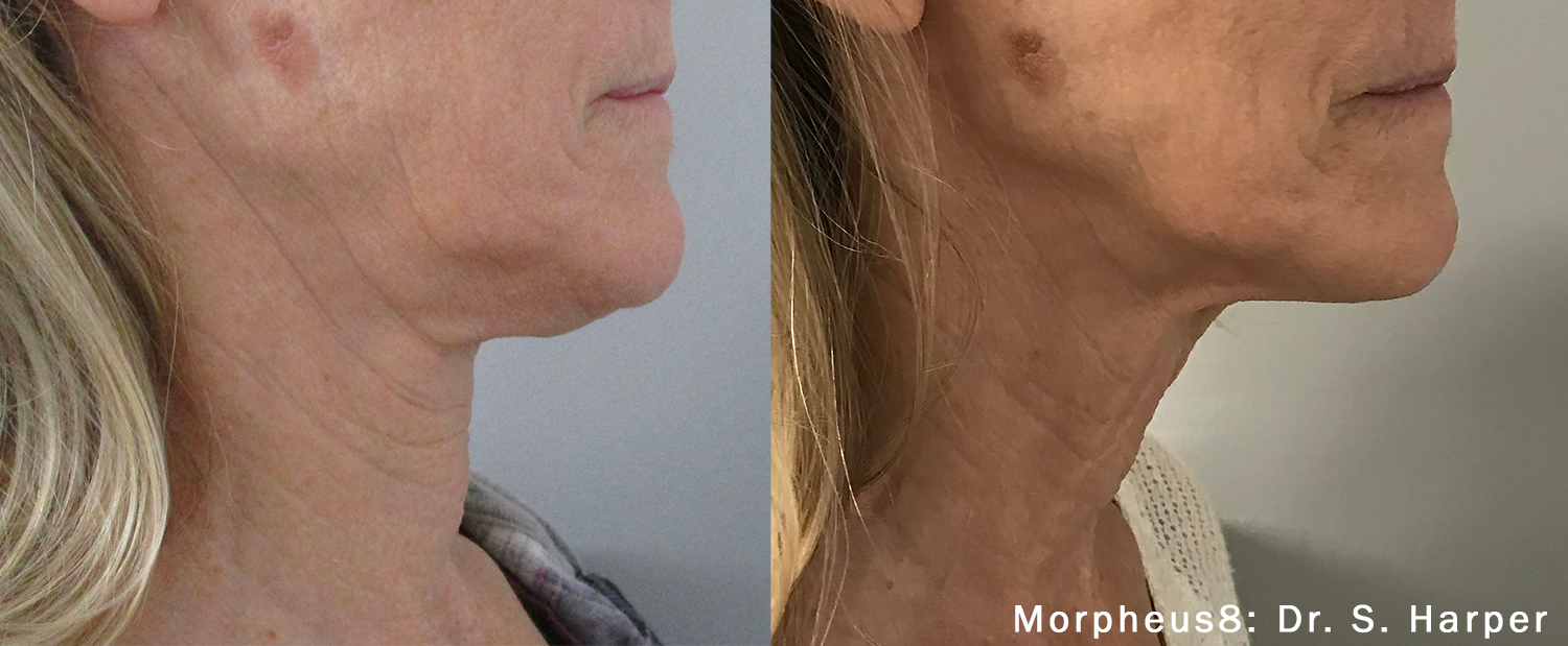 before and after morpheus 8 on the neck