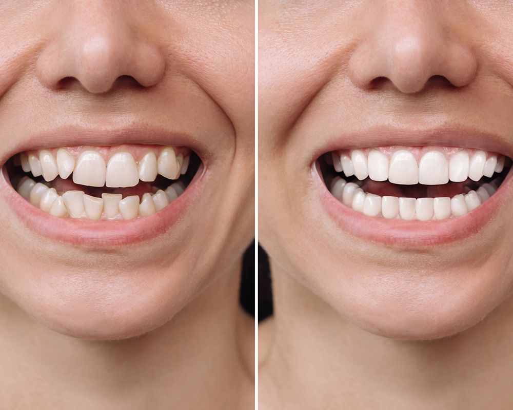 Before and after picture of a patient after getting cosmetic dentistry treatment in Bend, OR, at Highland Family Dental