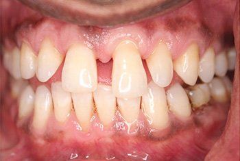 teeth before invisalign