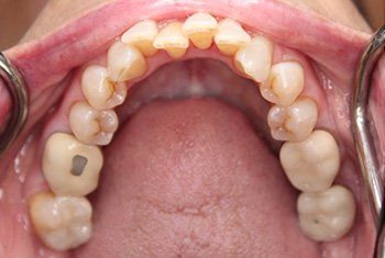 Invisalign lower teeth before 1