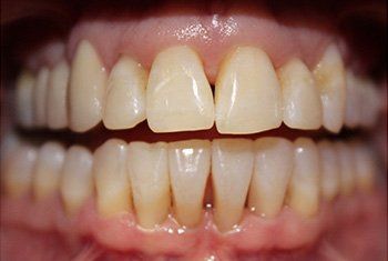 teeth after invisalign