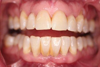 teeth before invisalign