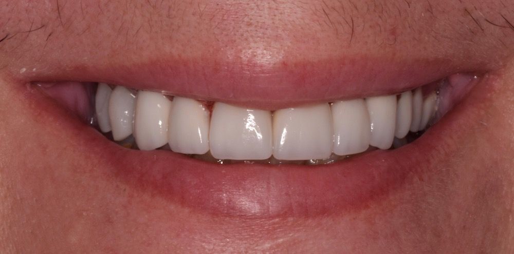 after invisalign 2