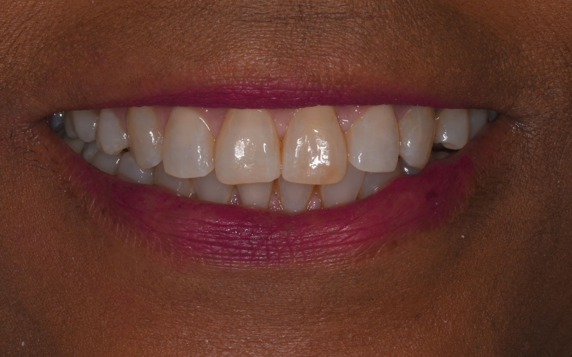 after invisalign 2