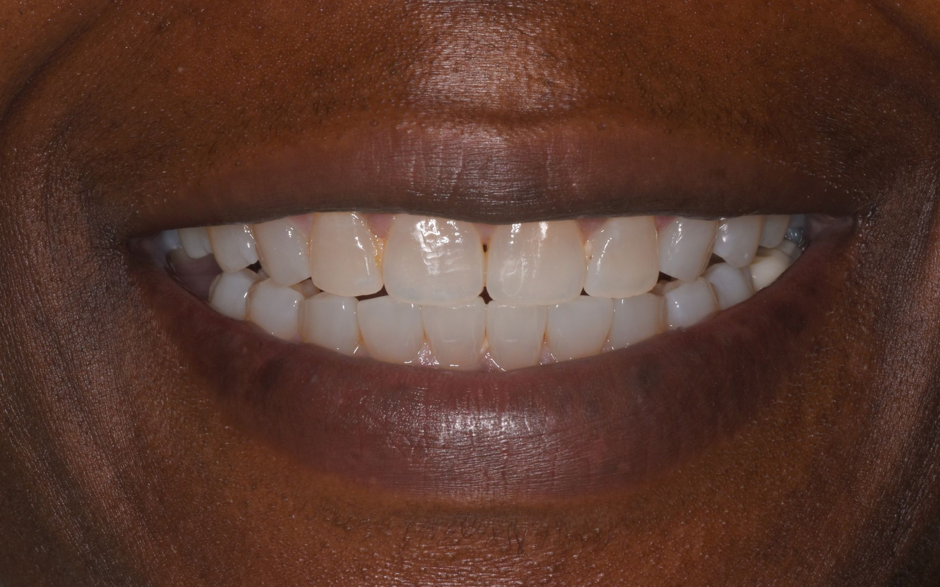 after invisalign 2