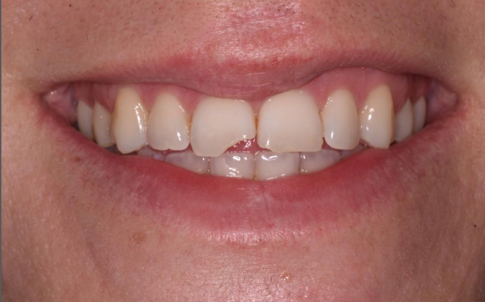 teeth before invisalign