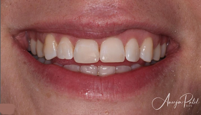teeth after invisalign