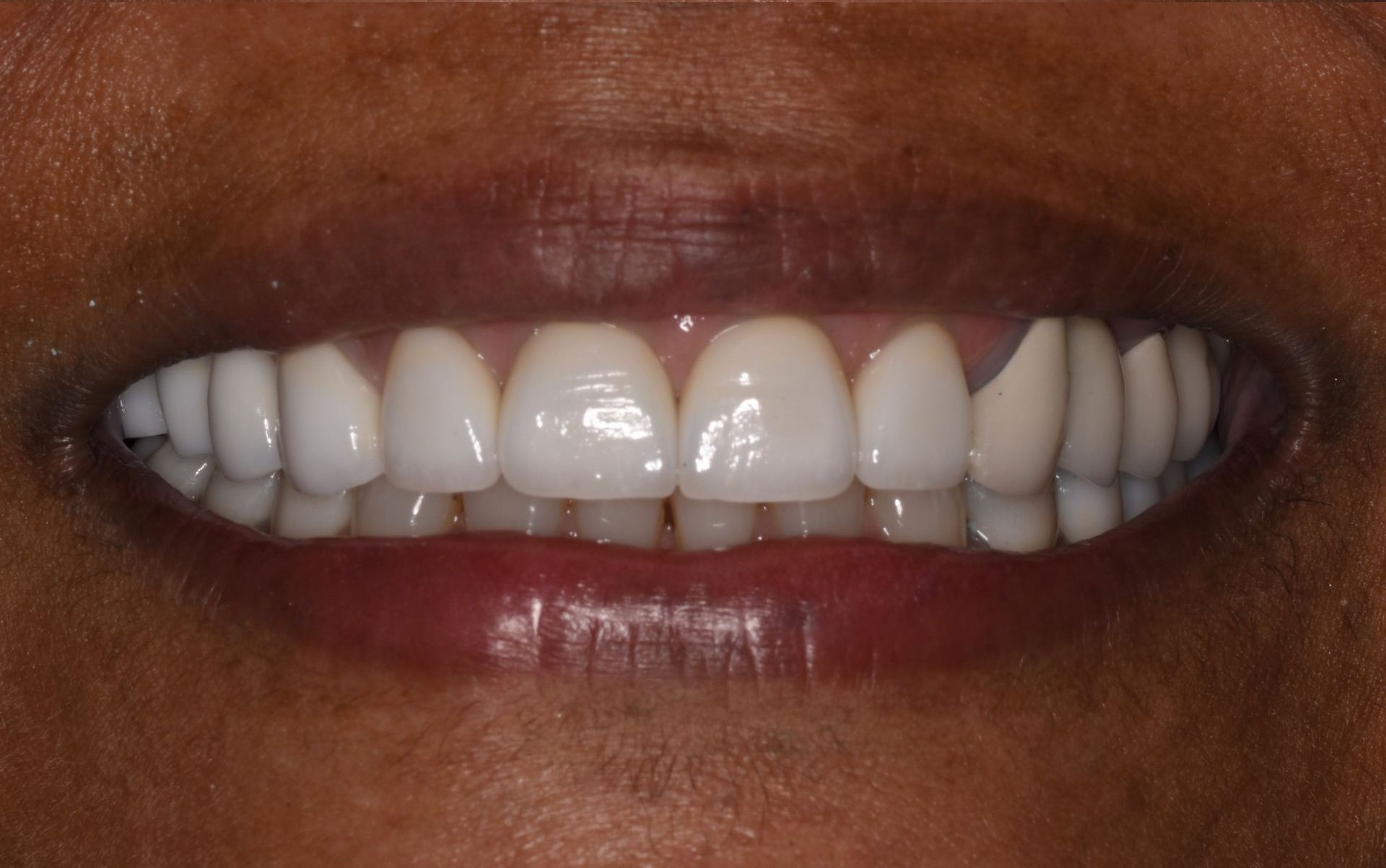 teeth after implant