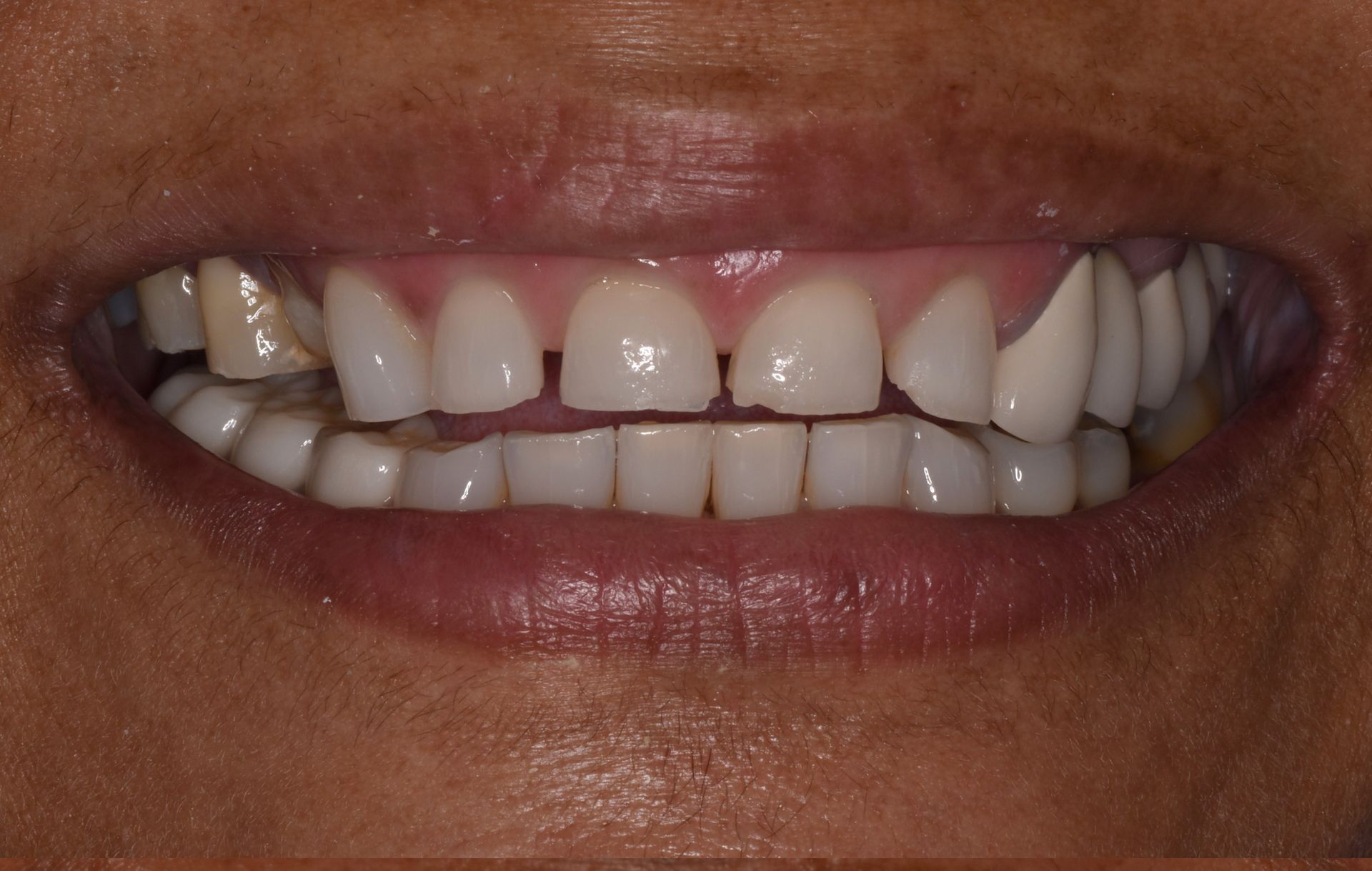 teeth before implant