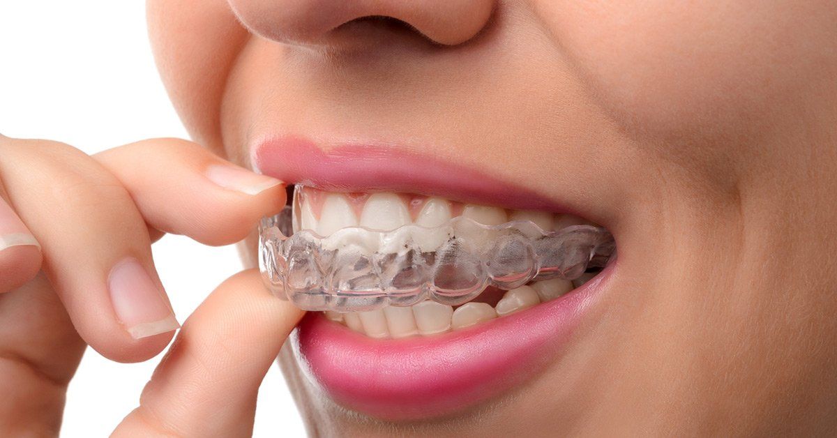 Invisalign® Clear Aligners vs Traditional Metal Braces: Which is best for  your smile? - Dental Care of Lombard