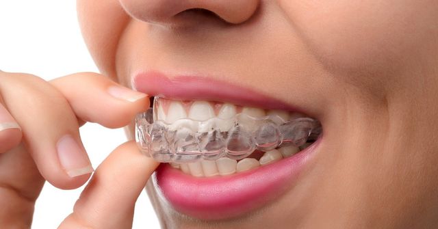 Don't Meddle with the Metal  7 Benefits of Invisalign Over