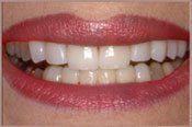 teeth after invisalign