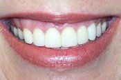 teeth after invisalign