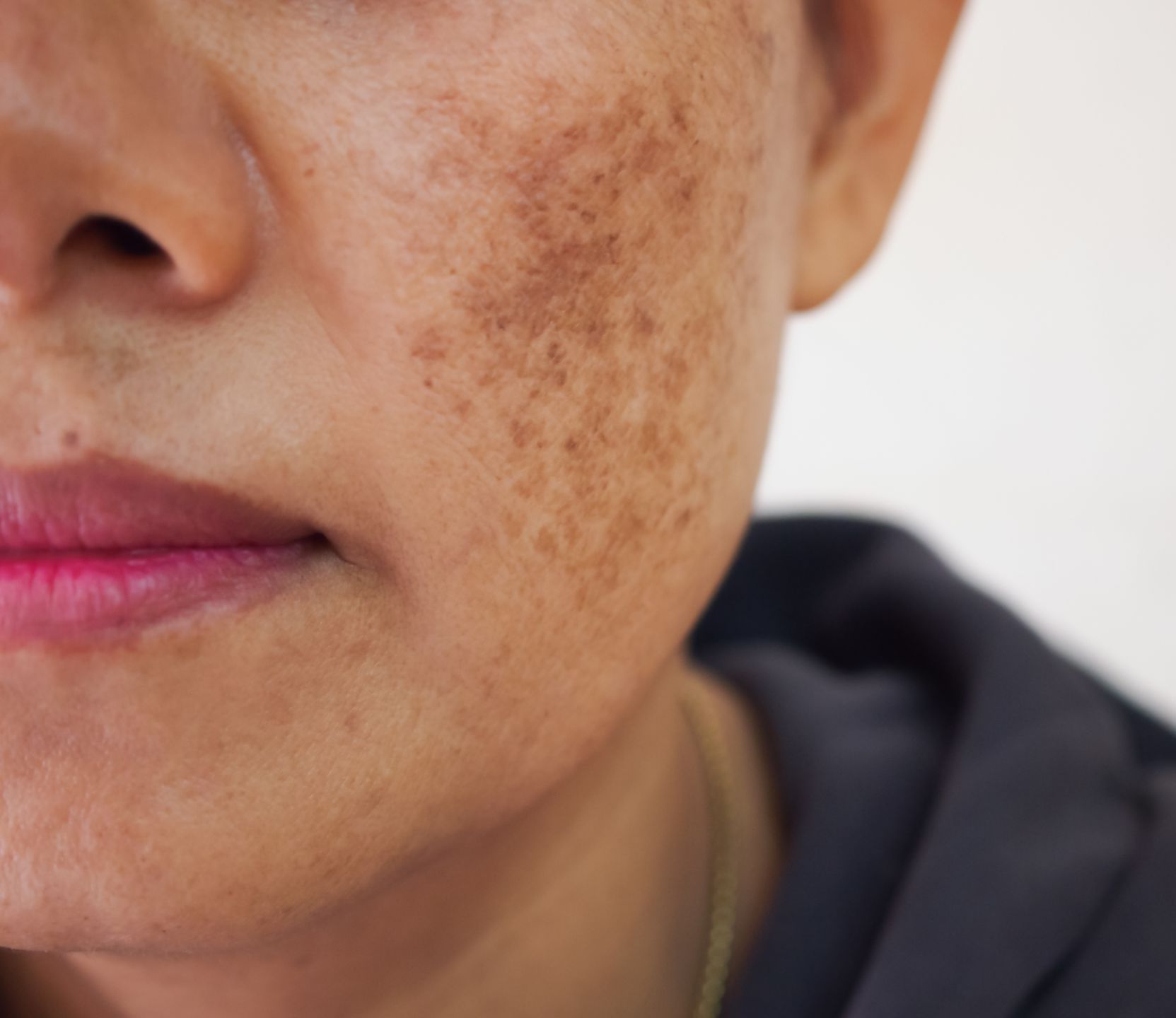 A close up of a woman 's face with brown spots on it.