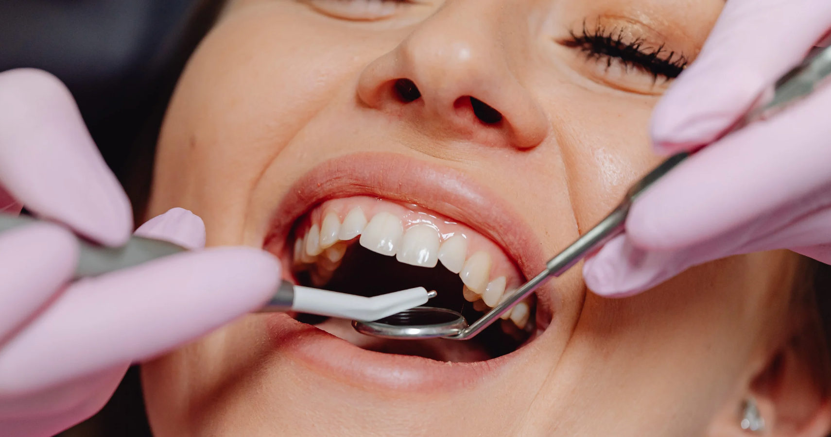 What Materials Are Used for Dental Crowns?
