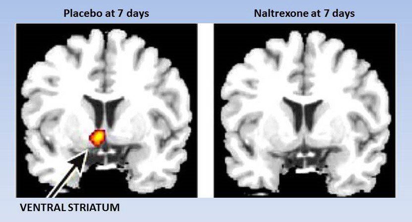 Naltrexone