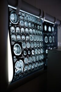 Hypoxic/Anoxic Brain Injuries Caused by Medical Malpractice cardaro & peek