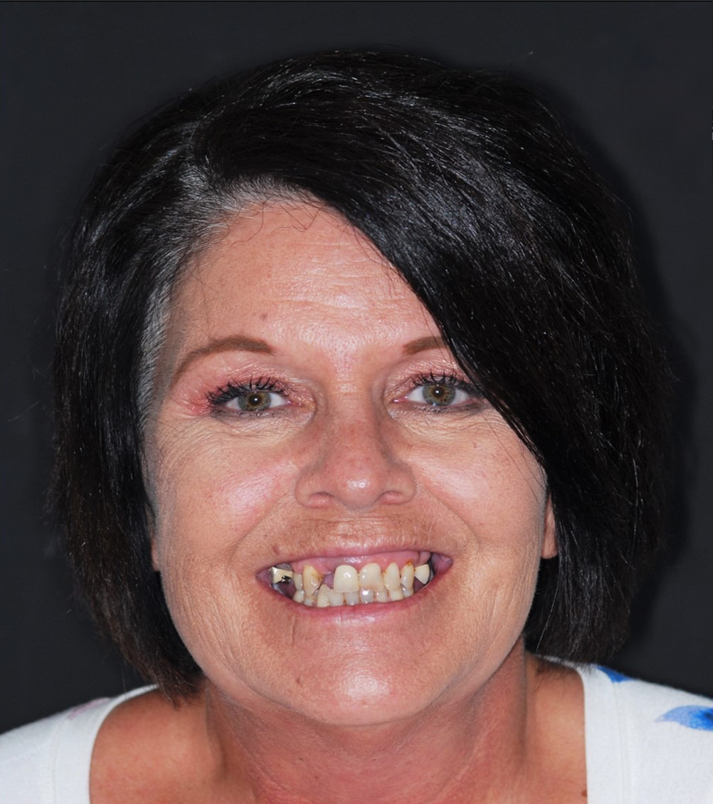 Woman smiling, showing missing teeth; dark hair, white top, against a black background.