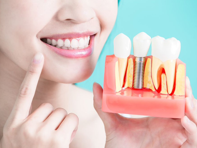 Woman smiling, pointing to a dental model showing a tooth implant, blue background.