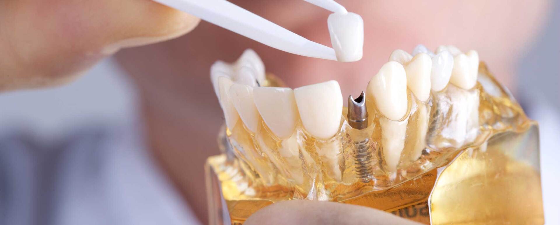 Doctor Showing Dental Implant — Bulleen, VIC — Bulleen Dental
