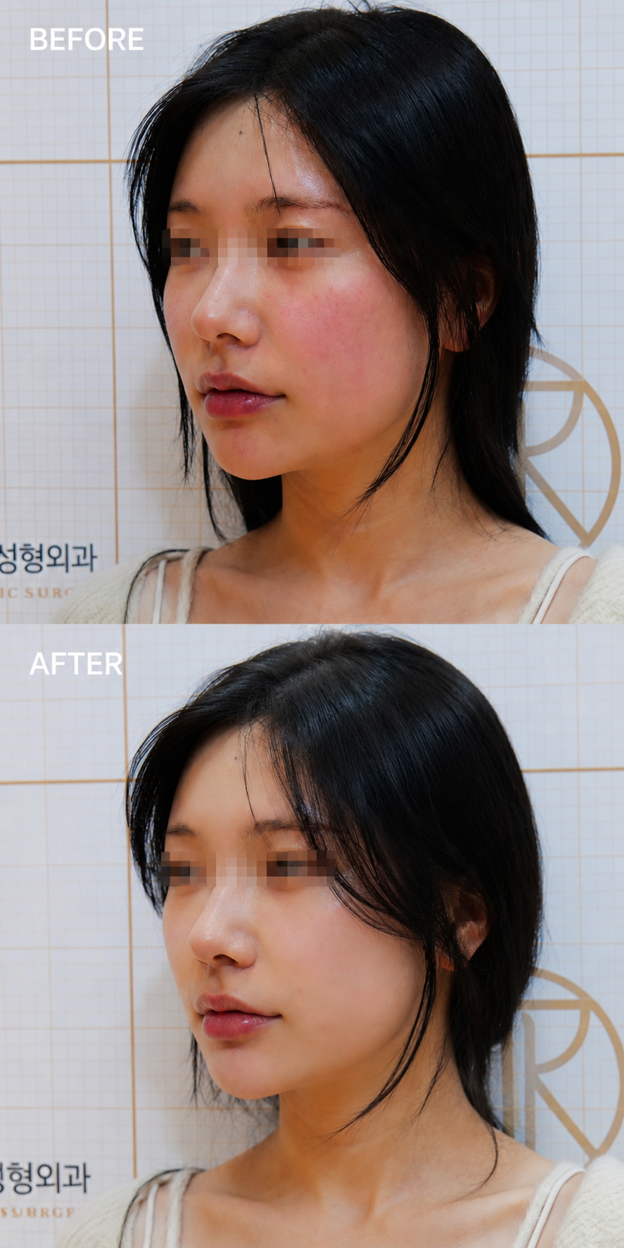 Sensitive-Skin Glow — before and after, JRYN Dermatology Seomyeon Busan