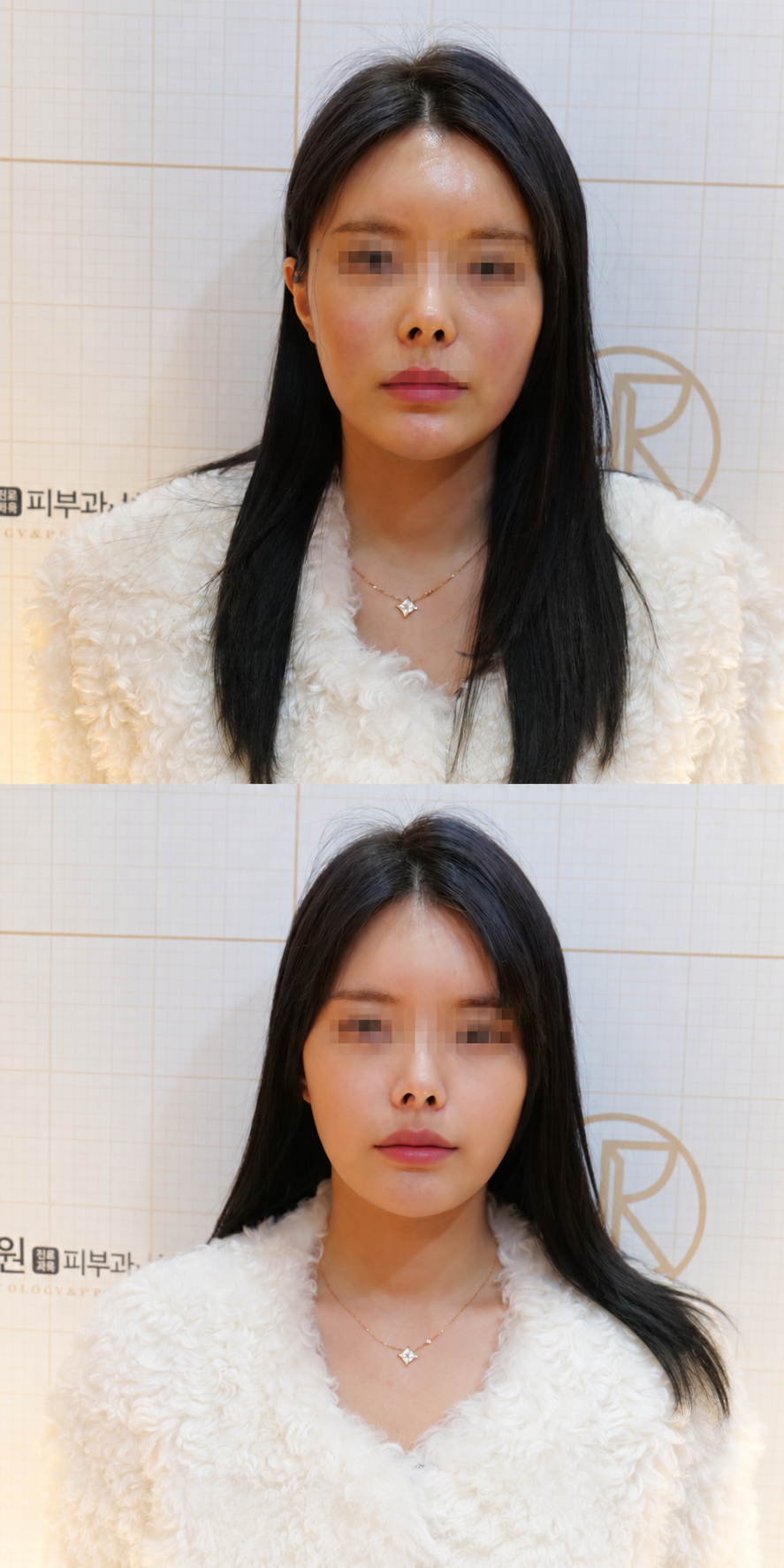 Contour Lifting — before and after, JRYN Dermatology Seomyeon Busan