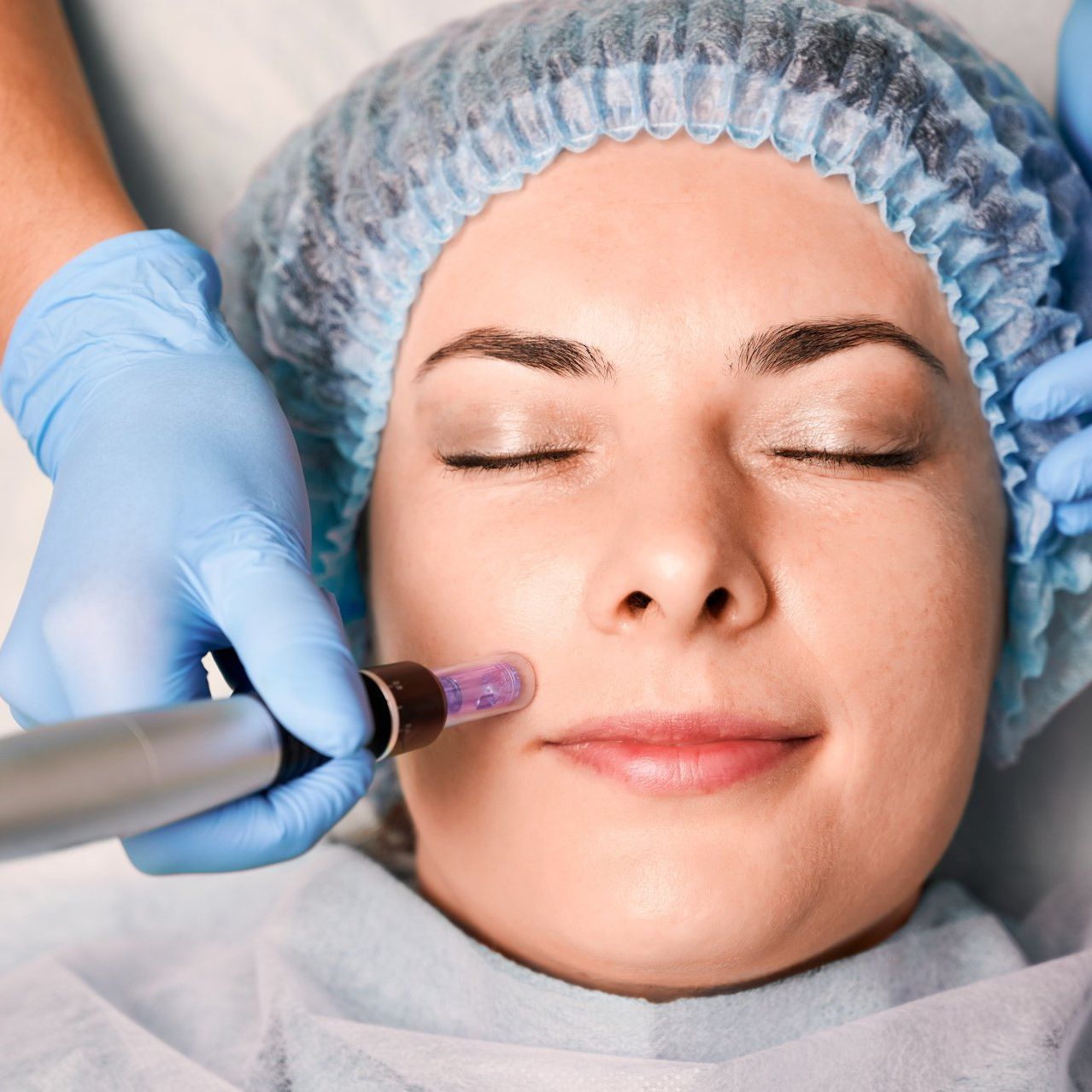 Micro-Needling (Collagen Induction Therapy) Bowral