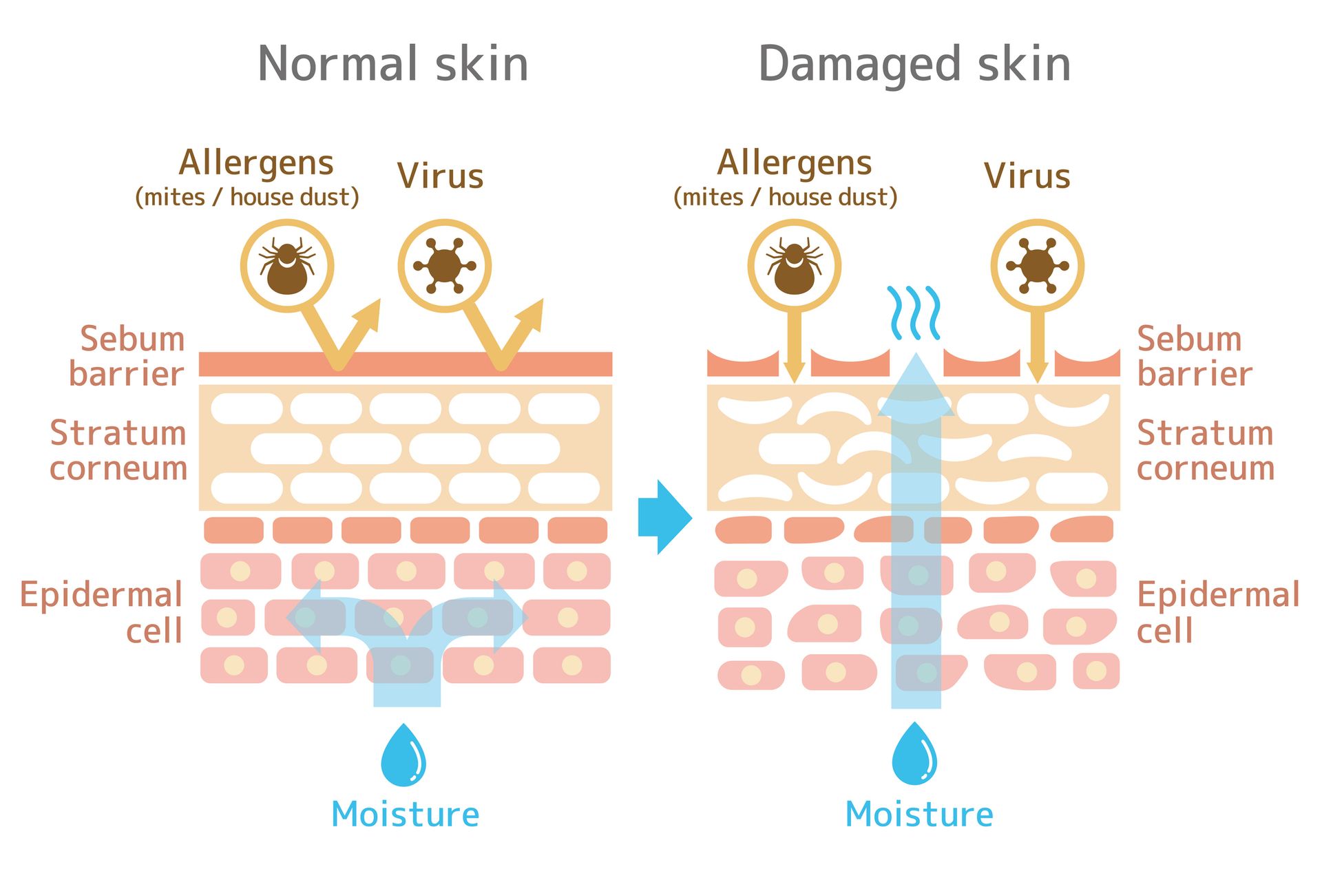 A diagram of a normal skin and a damaged skin.