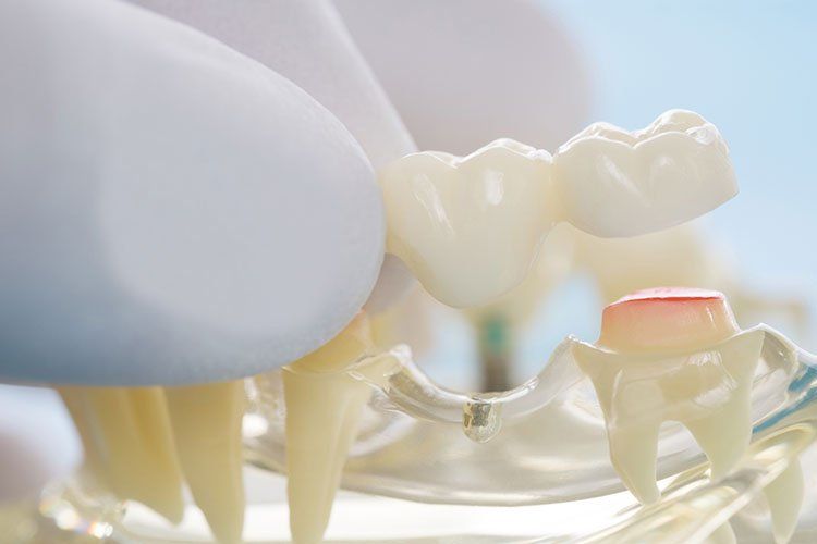 dental bridges up close