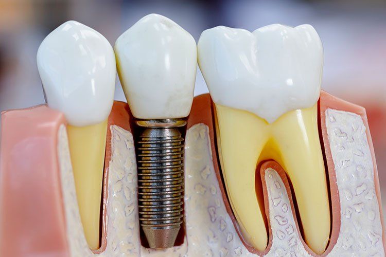 dental implants up close