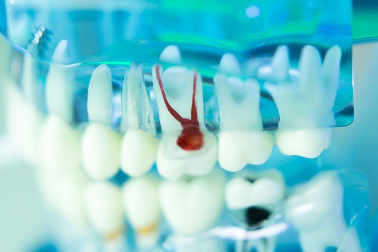 root canal