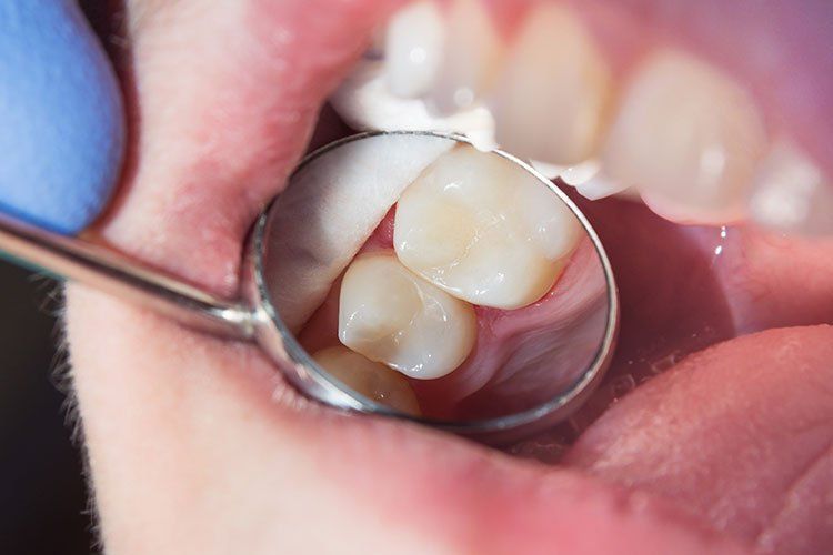 teeth checked by small mirror