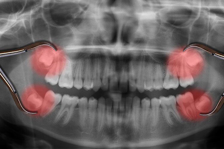 wisdom teeth x ray