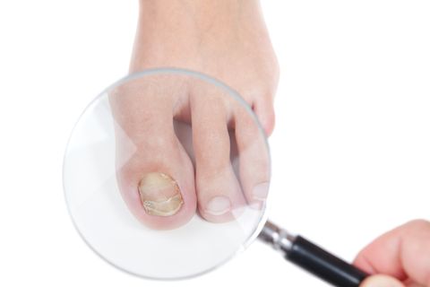 Toenail Fungus Treatment