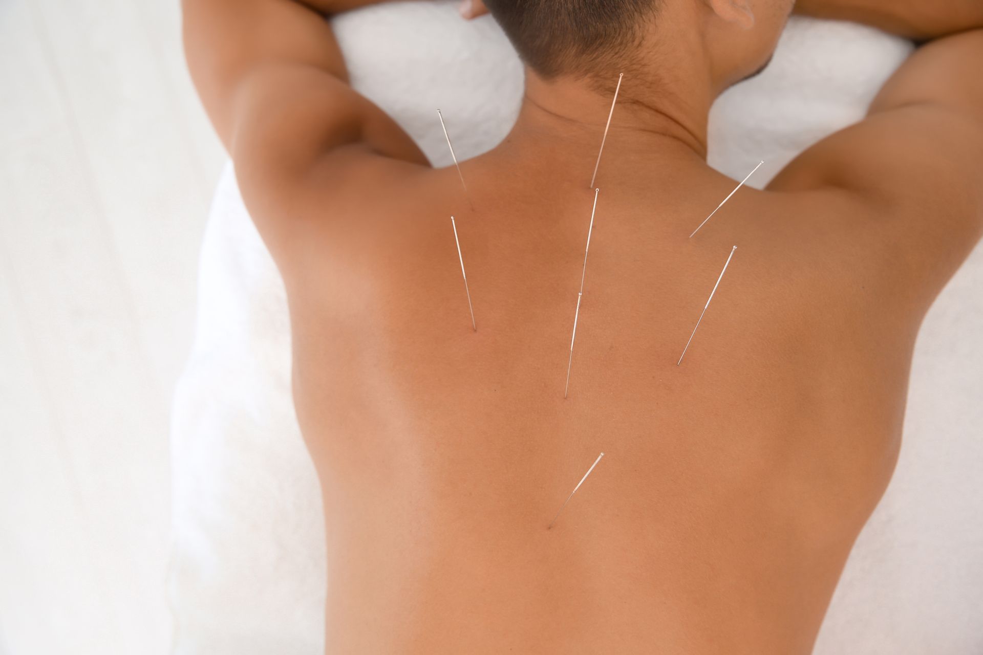 A man is getting acupuncture on his back to promote better sperm quality