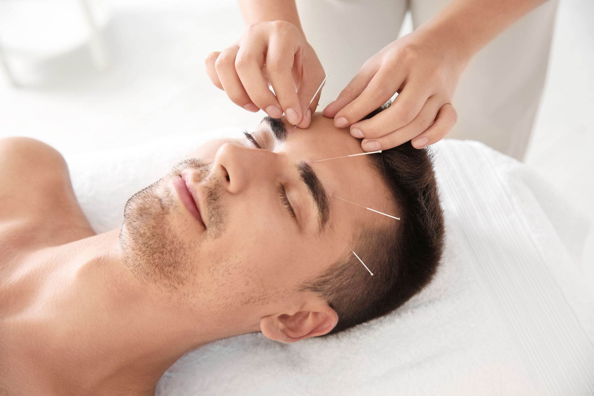 A man is getting acupuncture treatment on his forehead to promote better sperm quality