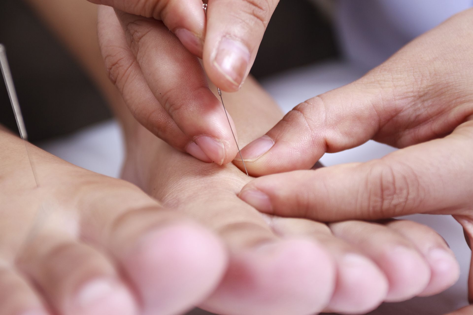 A pregnant person is getting acupuncture on their foot.