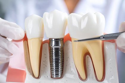 A dentist is holding a model of a tooth with a dental implant in Meridian, ID