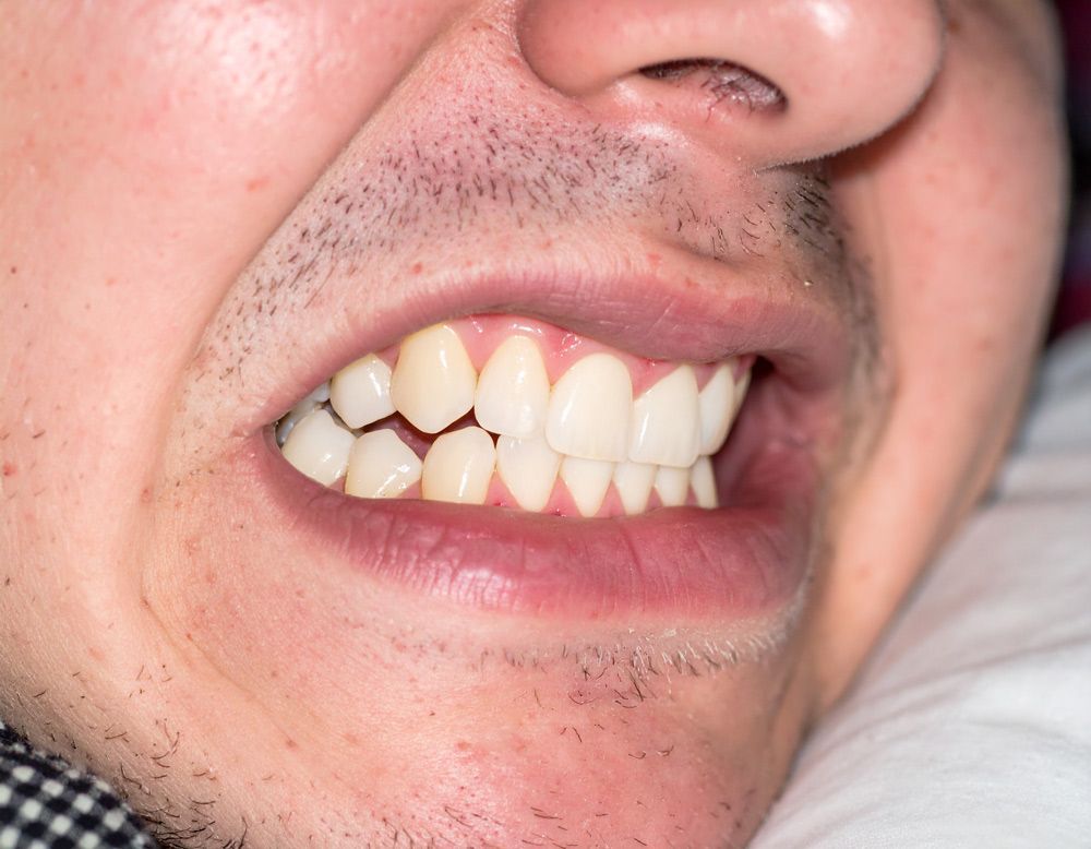 Sleeping and experiencing bruxism in Meridian, ID