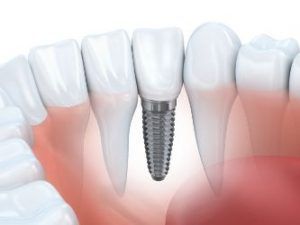 Dental Implant Meridian Idaho