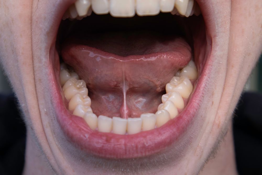 Open mouth showing teeth and tongue with visible frenulum.