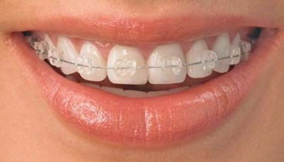 Attacchi tradizionali in ceramica