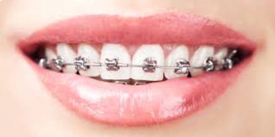 Attacchi tradizionali metallici