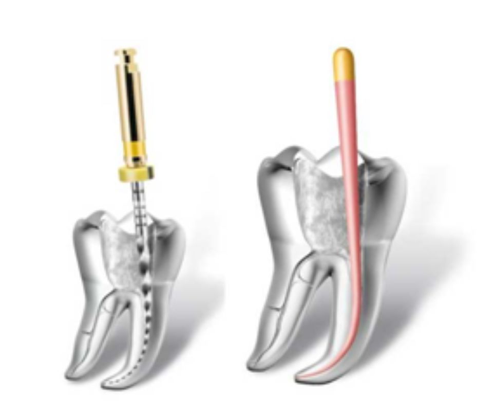 due denti con impianti