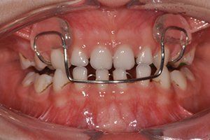 Apparecchio funzionale