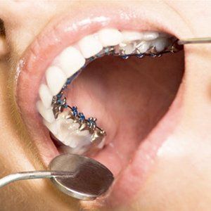 Ortodonzia fissa linguale