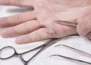 hand being sutured