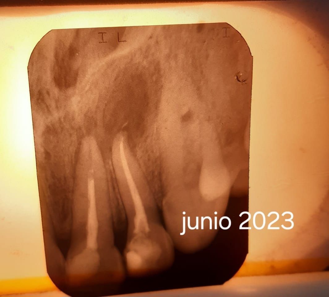 Radiografía dental que muestra conductos radiculares obturados y radiolucidez periapical. Fecha de junio de 2023.